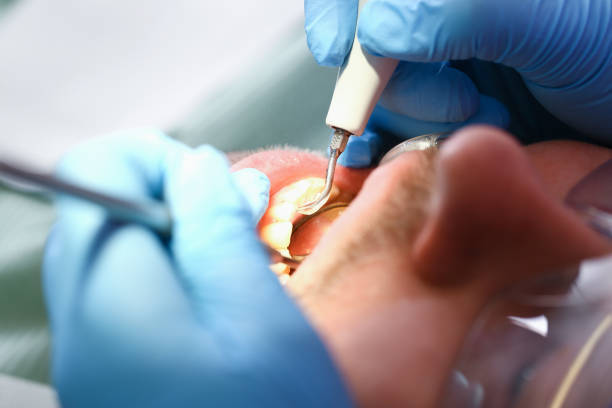 Best Emergency Dental Extractions in Carpentersvle, IL