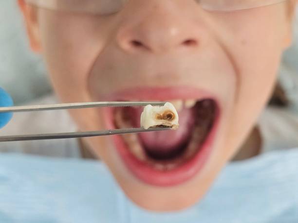 Best Emergency Dentist for Lost Fillings or Crowns in Carpentersvle, IL