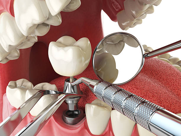 Best Emergency Root Canal Treatment in Carpentersvle, IL